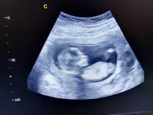 Ultrasound scan of 15 week-old baby